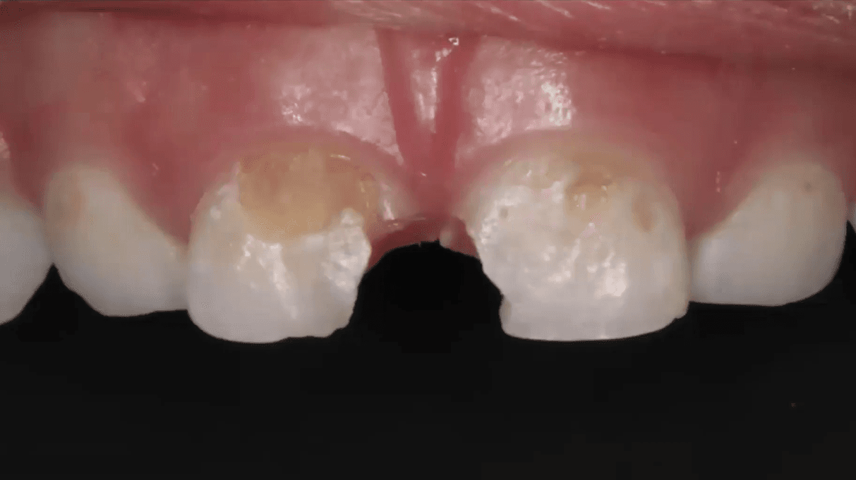 Modern Pulpal Therapy for Primary Teeth: Current Best Practices