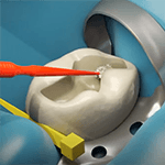 Streamlining Your Bonding Systems for Direct and Indirect Restorations