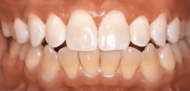 Tooth Whitening: In-Office, At-Home or Both?