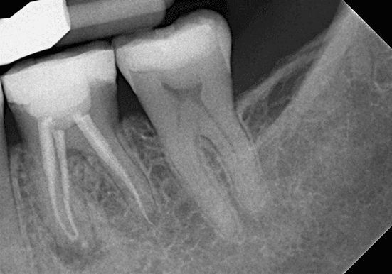 Is This a Case for an Apicoectomy?