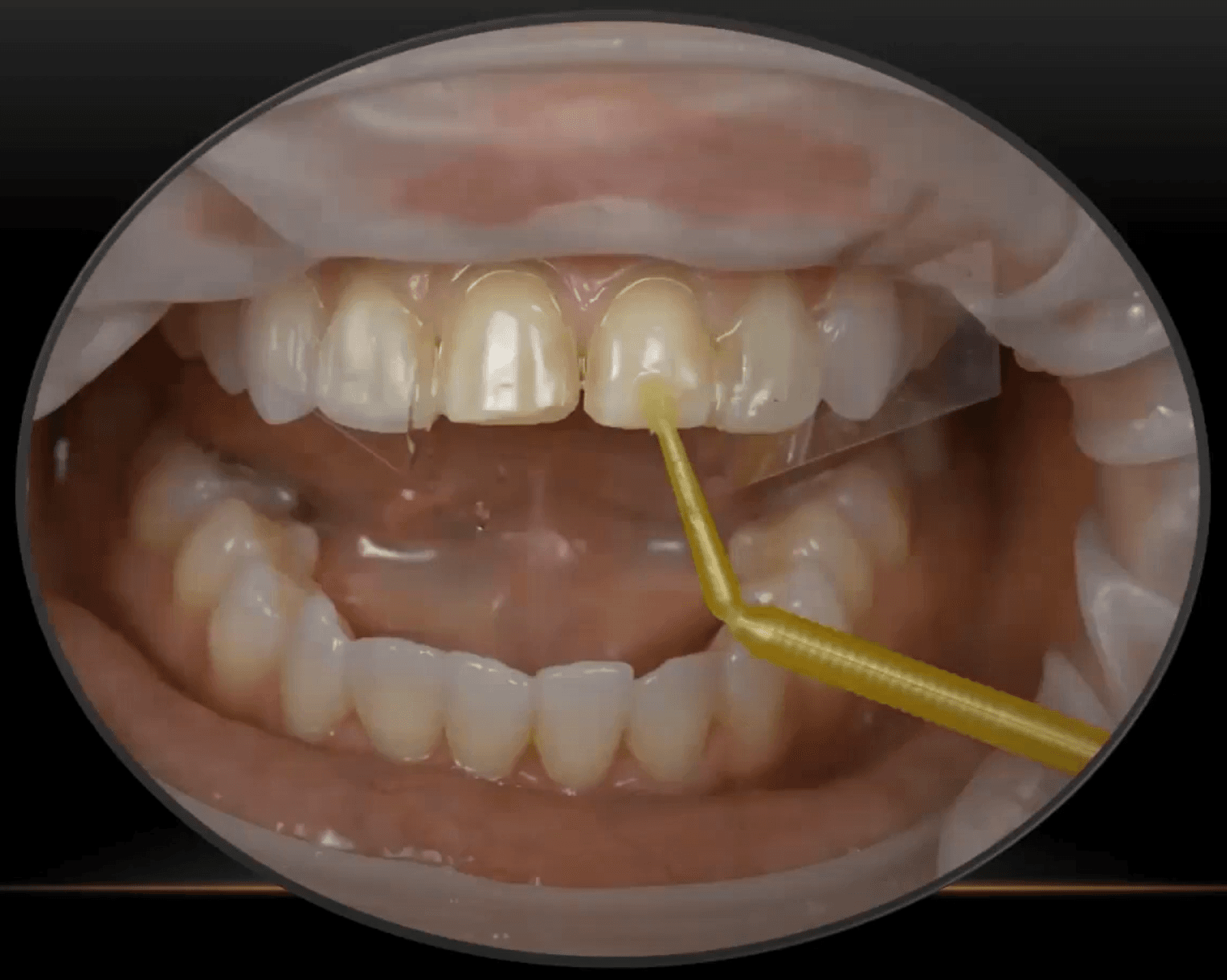 A Proven Approach for Veneer Cementation