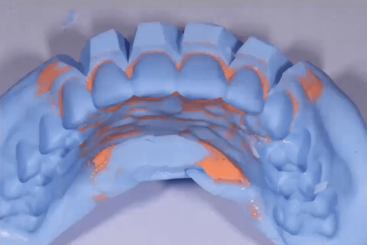 Tips for Temporaries in Cosmetic Dentistry