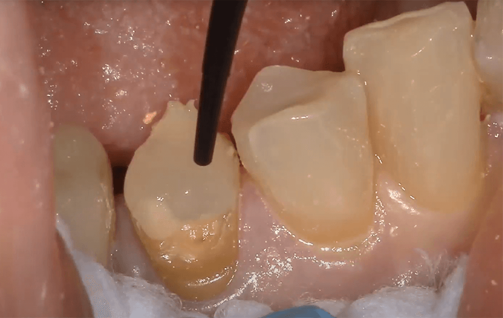 Using Short Fiber Reinforced Composites to Prevent Cracked Teeth
