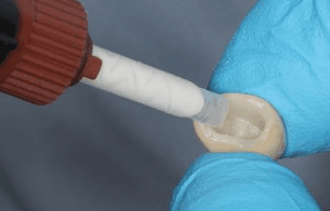 Zirconia vs. Emax: Expert Material Selection and Cementation Tips