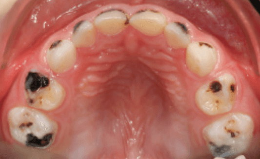 Using Silver Diamine Fluoride to Treat Active Decay