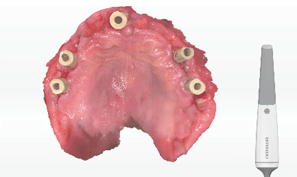 Digital Solutions for Implant Dentistry
