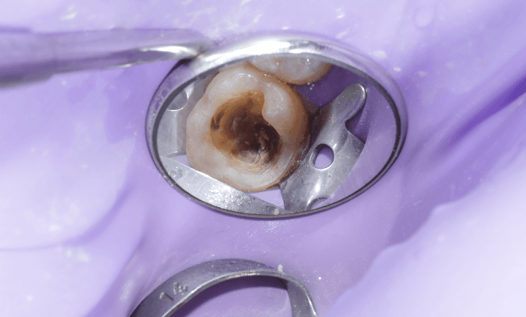 7 Tips for Success with Direct Composites